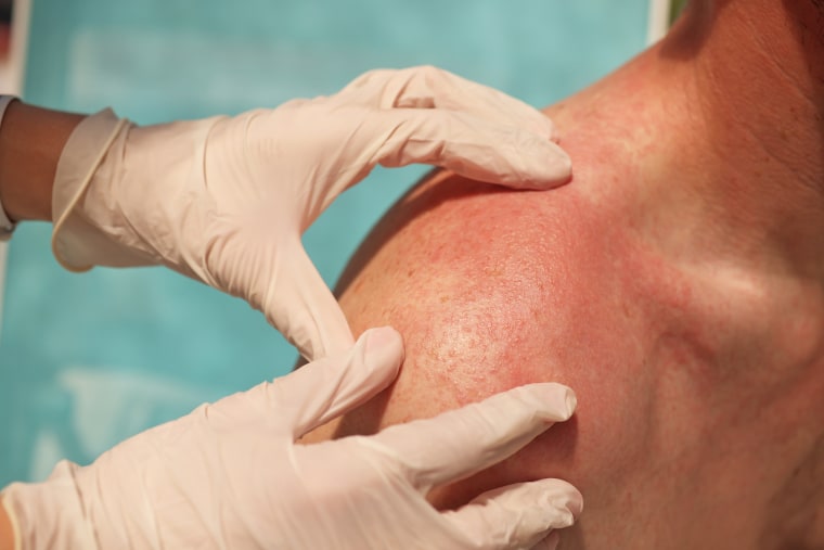 Doctor dermatologist examining rash on skin of man shoulders.