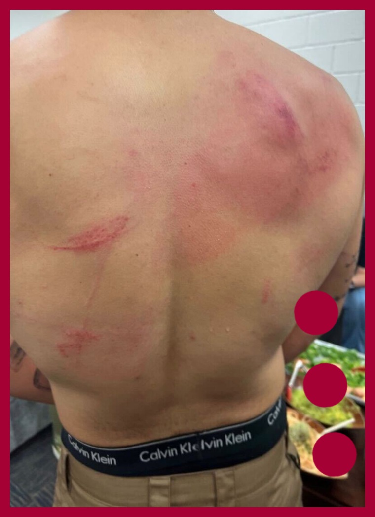 Bad Bunny muestra las terribles heridas en su espalda tras enfrentamiento  con Damian Priest