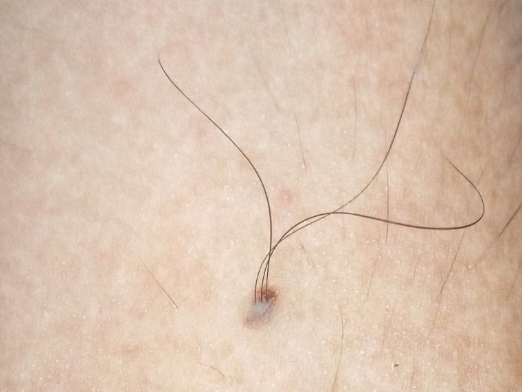 A mole with three hairs growing in the middle.