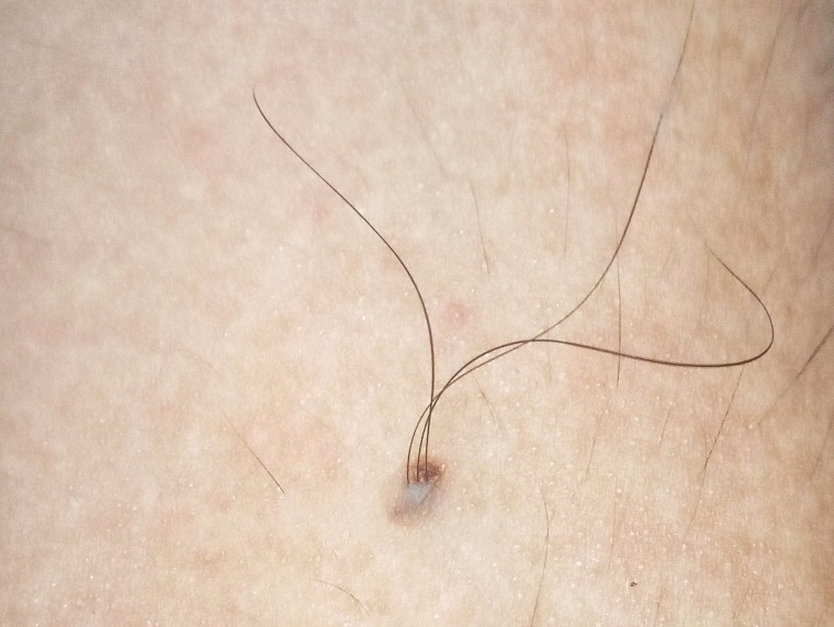 Skin moles that grow hair may offer treatment for baldness study