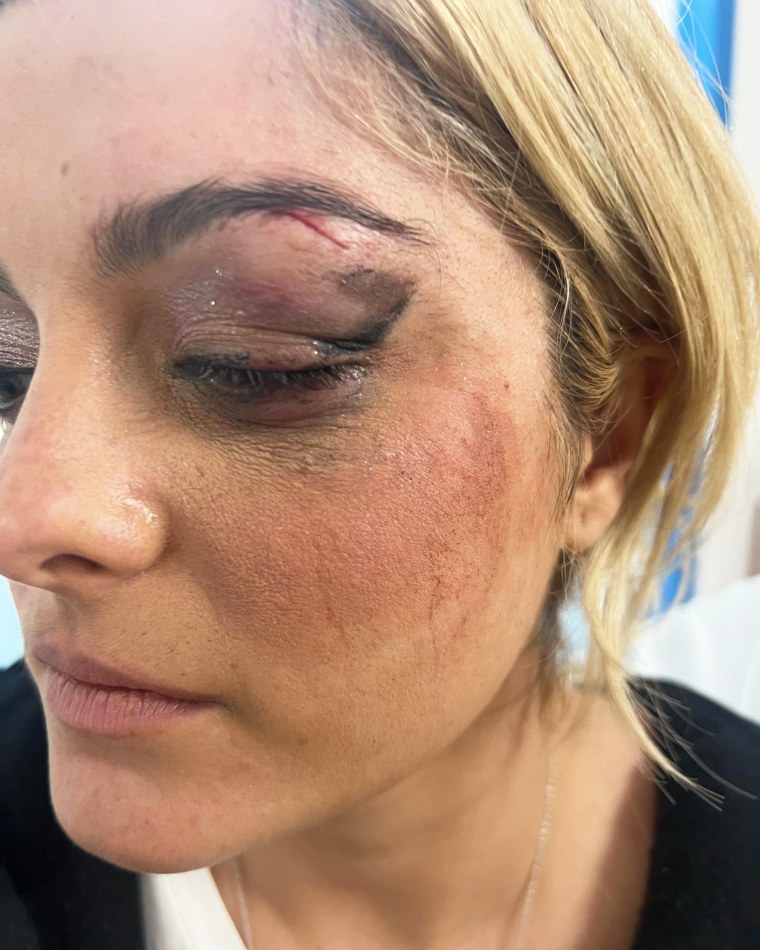 Rexha shared this photo of her injury on Instagram.