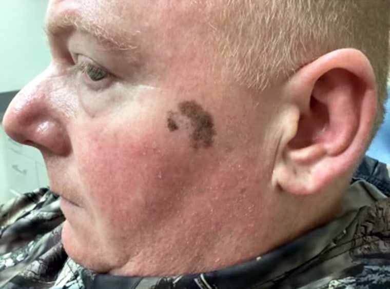 Chris Meffen first noticed the spot on his cheek several years ago. It had been getting larger, but "I probably would have continued ignoring it," he says.