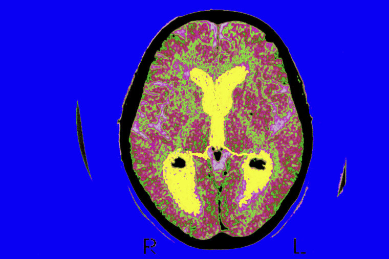 A brain scan of a patient affected by Alzheimers disease. 