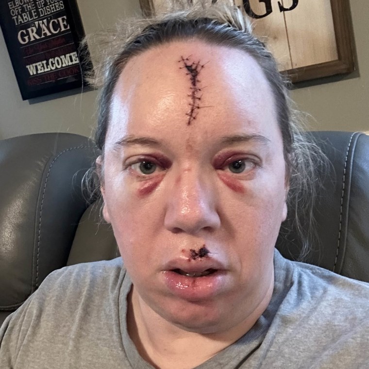 Woman Warns About Passing Out After Fainting Causes Face Scar