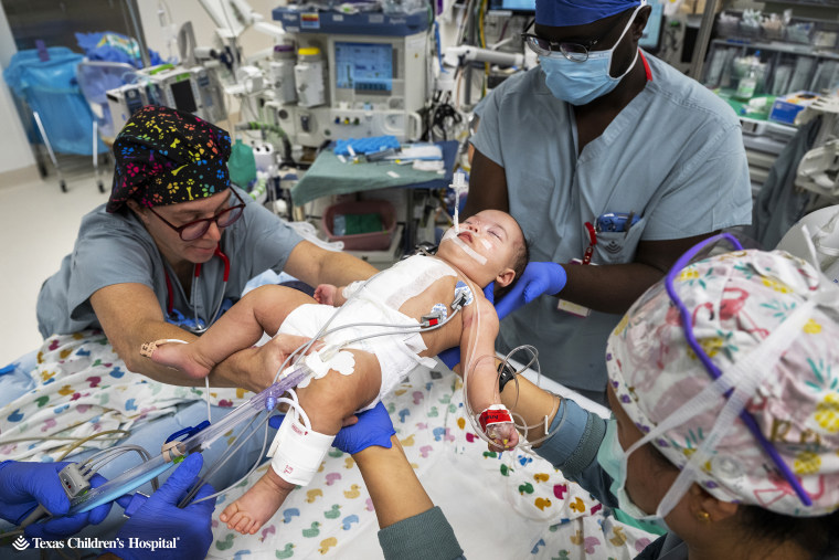 It took a team of 17 staff to separate baby Ella and Eliza, twins born conjoined by the abdomen.