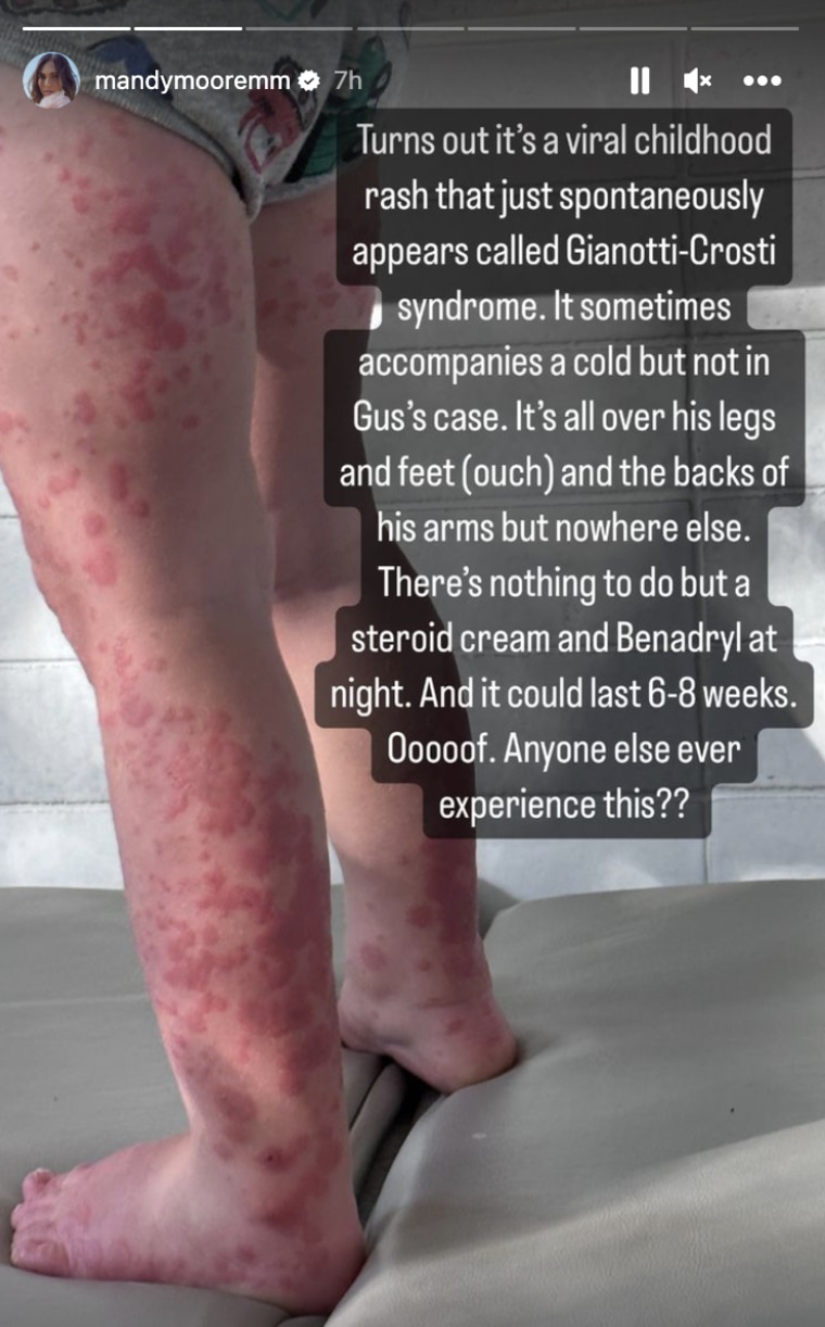 An up close shot of a young boy's legs covered in red splotches