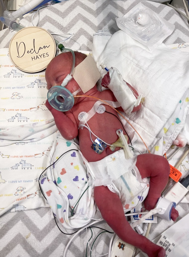 Declan, shortly after he was born premature at 32 weeks.
