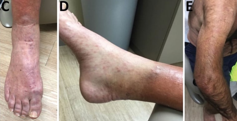 Lepromatous leprosy in a 54-year-old man in central Florida in 2022.