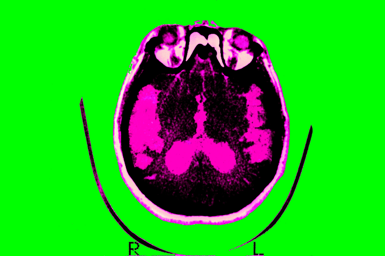 Scan of the brain of a patient with Alzheimer's.