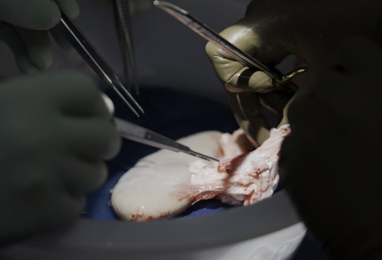 Surgeons at NYU Langone Health prepare a pig's kidney for transplant