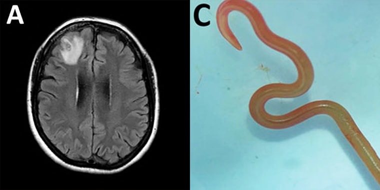 Live parasite found in womans brain in Australia