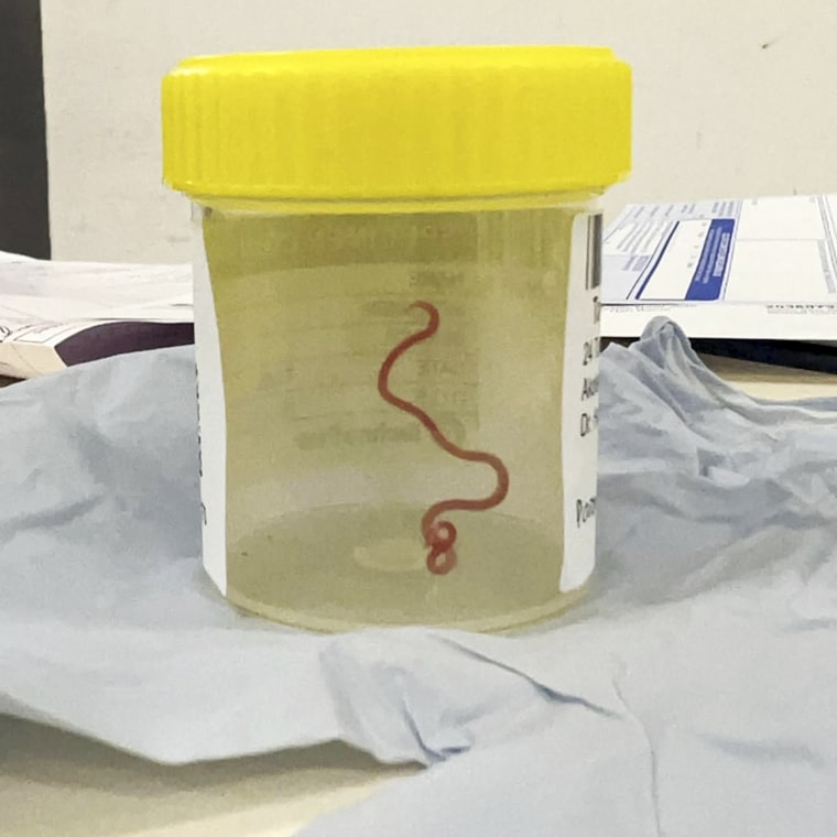 This undated photo supplied by Canberra Health Services, shows a parasite in a specimen jar at a Canberra hospital in Australia. 