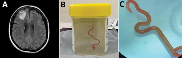 Live 3-inch long python worm found in woman's brain, the 1st adult case in world
