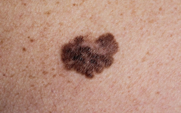 Melanoma - a malignant tumor of the skin