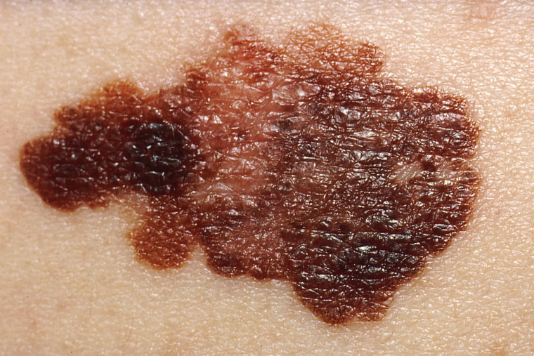 picture of melanoma