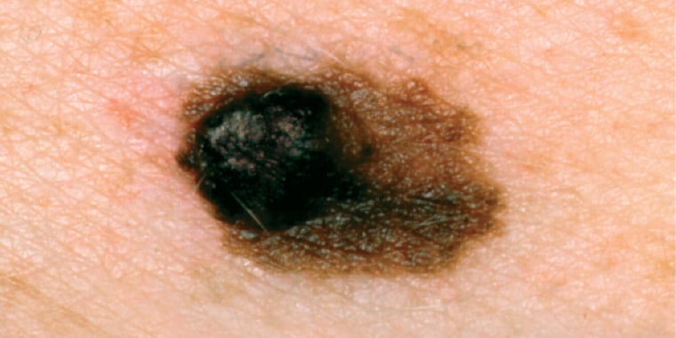 picture of asymmetrical melanoma