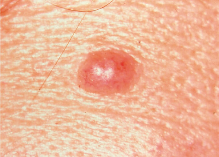 slightly asymmetrical but non-cancerous mole