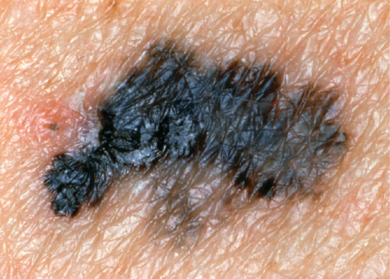 picture melanoma with irregular border