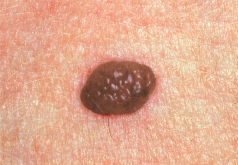 picture of benign mole irregular border