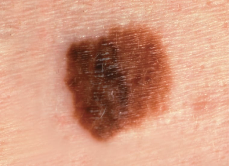 A picture of a melanoma with a diameter of greater than one-quarter inch.