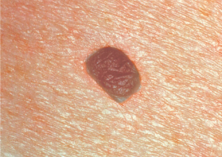 A picture of a benign melanoma approaching one-quarter of an inch.