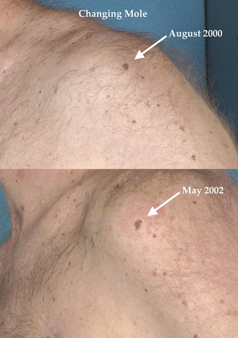 A melanoma that illustrates how cancerous moles may evolve in shape and size over time.