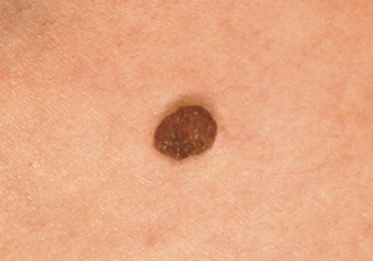 A noncancerous mole illustrating how there can be slight color variations within the mole but it's still benign.