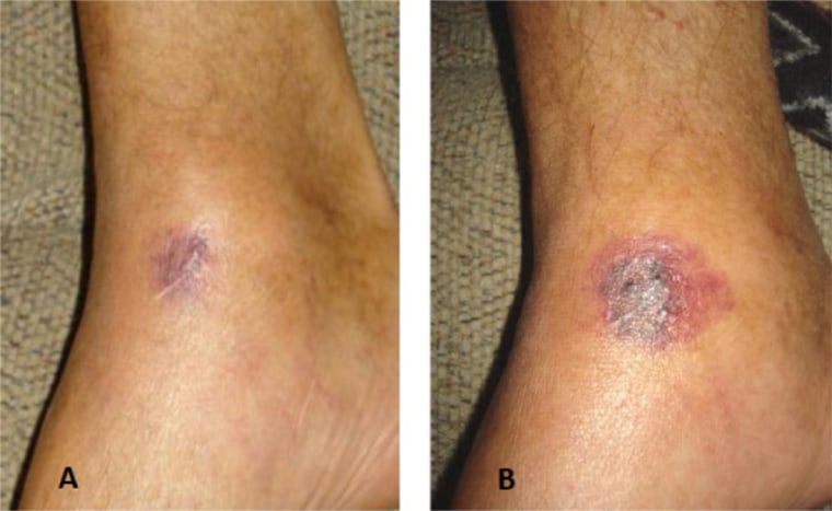 Rapidly developing and fatal Vibrio vulnificus wound infection