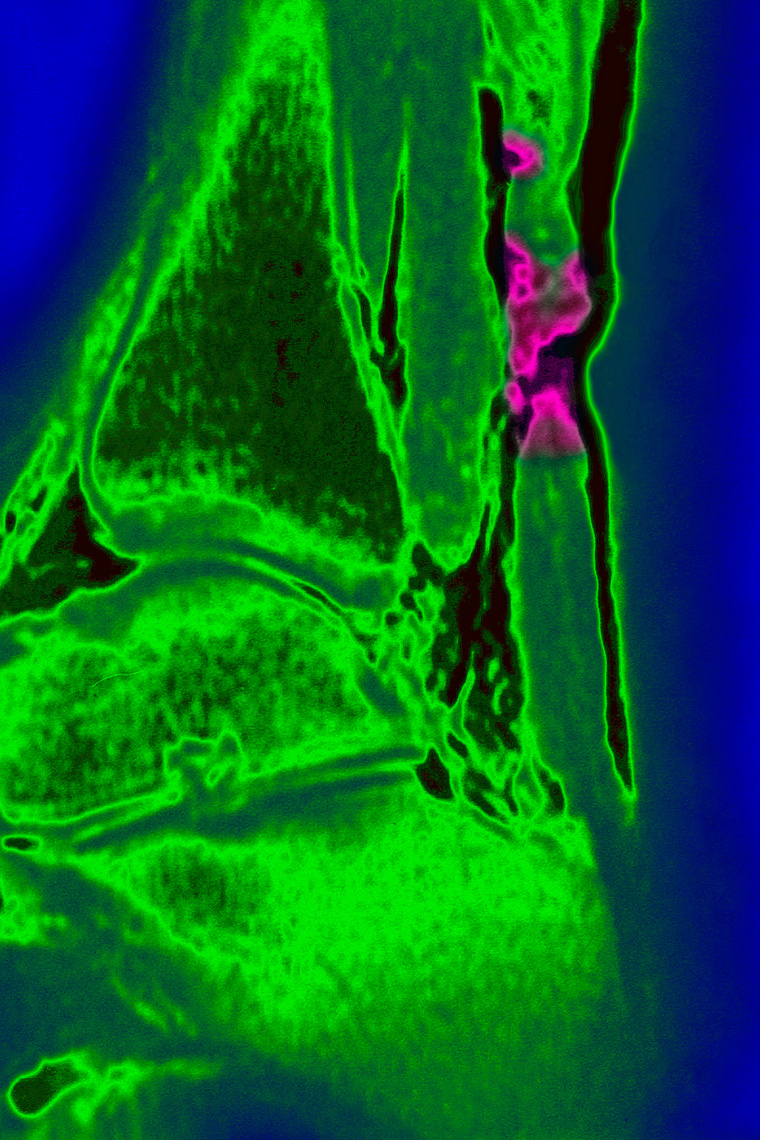 A ruptured Achilles tendon on a sagittal section MRI scan of an ankle. 