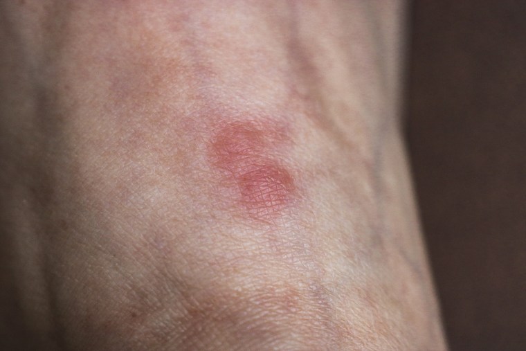 Red inflammation from an ant bite to the skin of the foot.