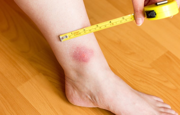 Identifying Insect Bites: Pictures Of 11 Common Bug Bites