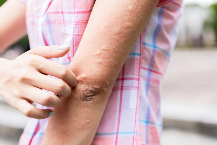 23 Pictures Of Skin Rashes With Symptoms Treatments Expert Tips