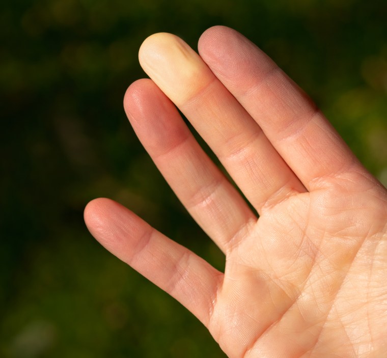 Fingers with Raynauds syndrome.