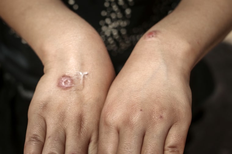 The most common form of leishmaniasis causes skin sores from the bite of Phlebotomine sandflies.