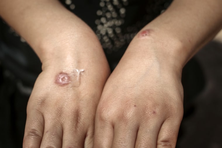 The most common form of leishmaniasis causes skin sores  from the bite of Phlebotomine sandflies.