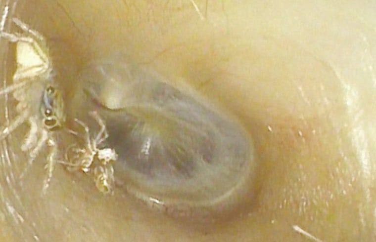 A small spider moving about a 64-year-old woman's ear canal next to its discarded exoskeleton