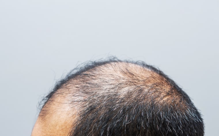 Minoxidil is used to treat thinning hair. But some patients might have trouble finding it at their local pharmacies.