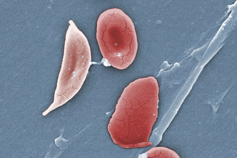 A microscope image of sickle cell and red blood cells.
