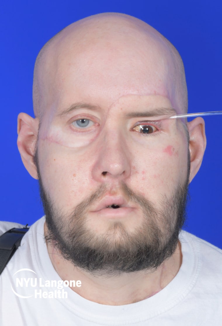 Aaron James after the face and whole eye transplant.