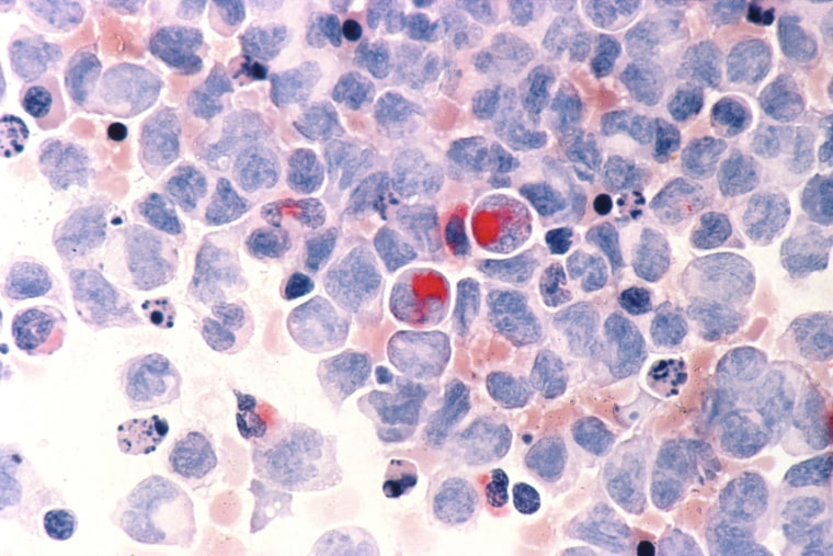 Microscope of human cells with acute myelocytic leukemia. 