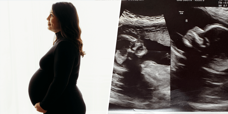 Kelsey Hatcher beside the sonogram of her rare double pregnancy.