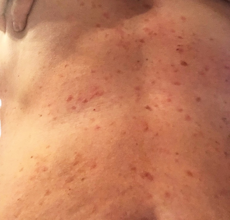 When Jill Zinsmeyer experienced temperature changes, she developed a brown splotchy rash that burned, a symptom of systemic mastocytosis, a rare condition impacting mast cells.