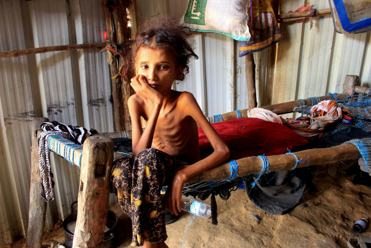 Image: Yemeni 10-year-old girl Ahmadia Abdo, who weighs ten kilograms due to acute malnutrition, sits on her bed at a camp for the internally displaced in the northern Hajjah Governorate, on Jan. 23, 2021.