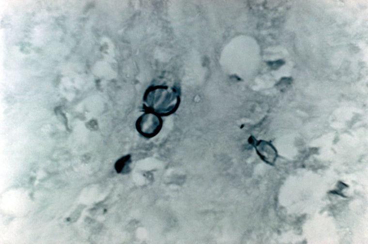 Methenamine silver stain photomicrograph of the histopathologic changes in blastomycosis due to Blastomyces dermatitidis in 1972.