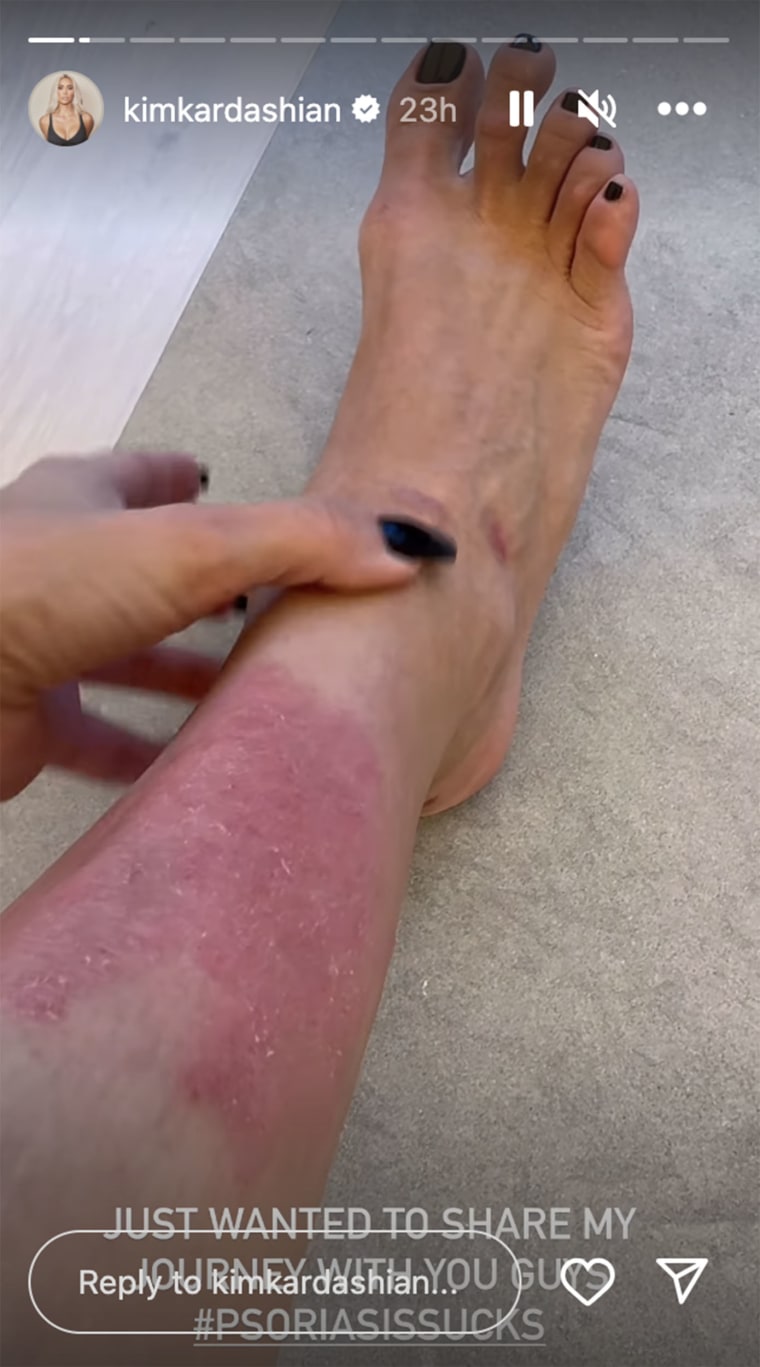 Kim Kardashian shares up close pics of her psoriasis and her hack for easing her symptoms