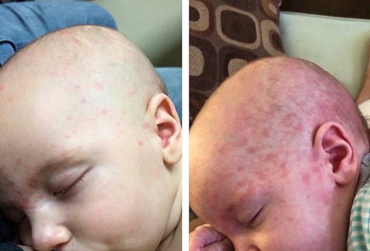 Mobius was 4 months old when he became sick with measles after visiting Disneyland in 2015. Babies are vulnerable because they aren’t routinely vaccinated against the virus until 12 to 15 months.