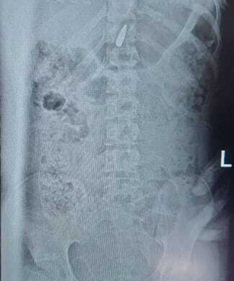 An X-ray showing the bullet in Salma Alyazji's spinal column.