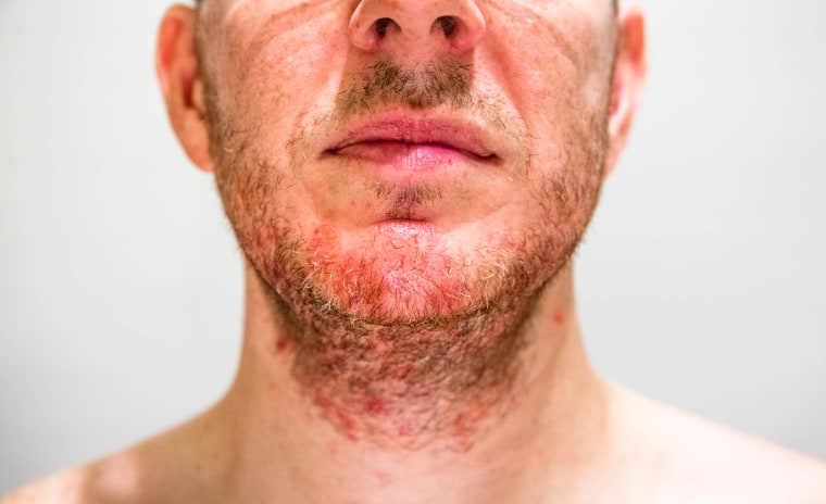 Folliculitis often appears in areas where you shave.