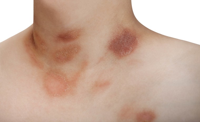 One person with Pityriasis rosea disease on the chest and neck