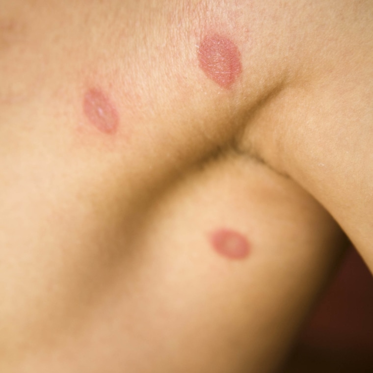 Woman Body Skin Rash Treatment Before After Stock Photo - Alamy